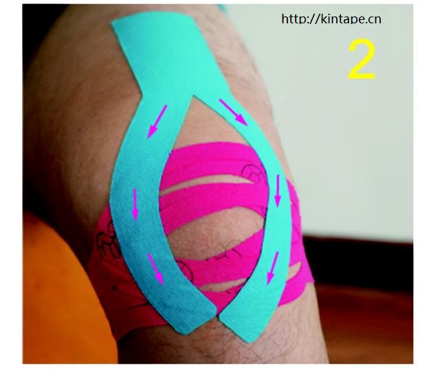 医用肌贴针对膝盖部不适引起的症状(关节炎,半月板受损等)